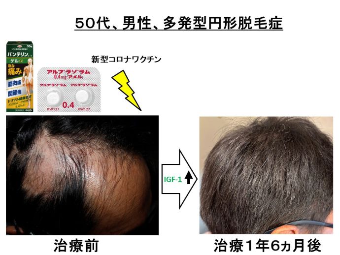 円形脱毛症　病院